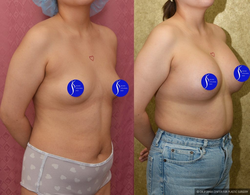 Breast Augmentation Before & After Patient #13866