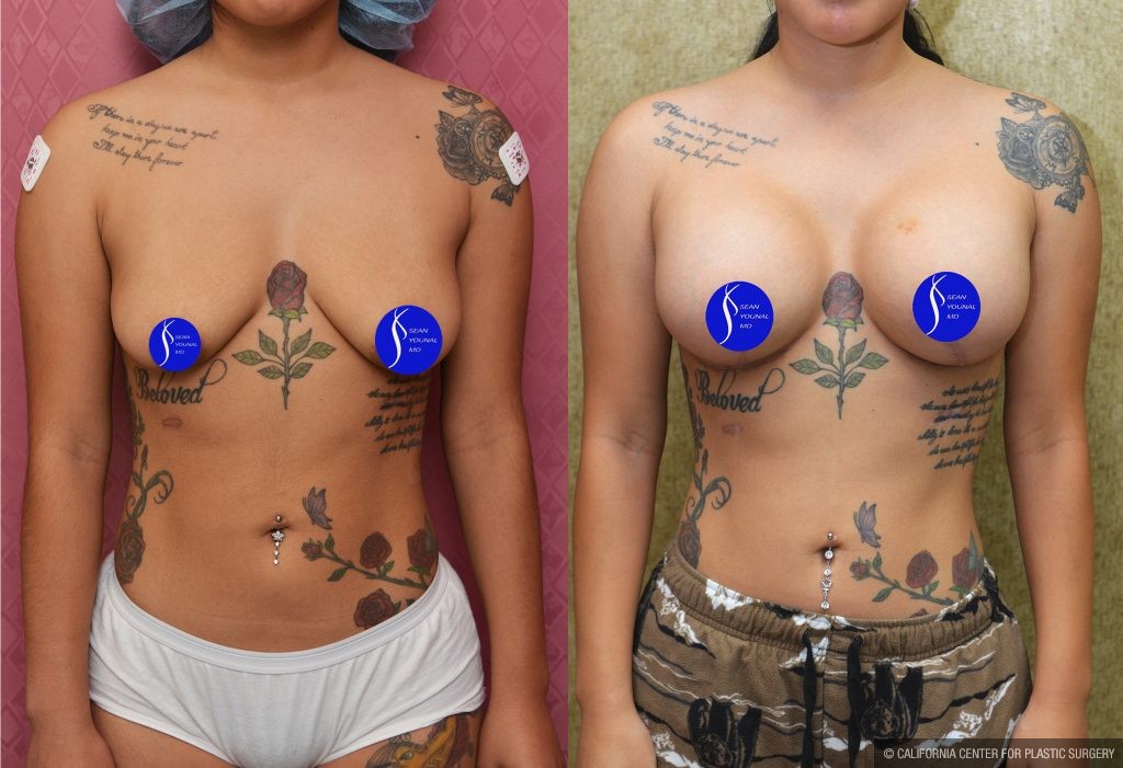 Breast Lift - Moderate Before & After Patient #13867