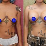 Breast Lift - Moderate Before & After Patient #13867