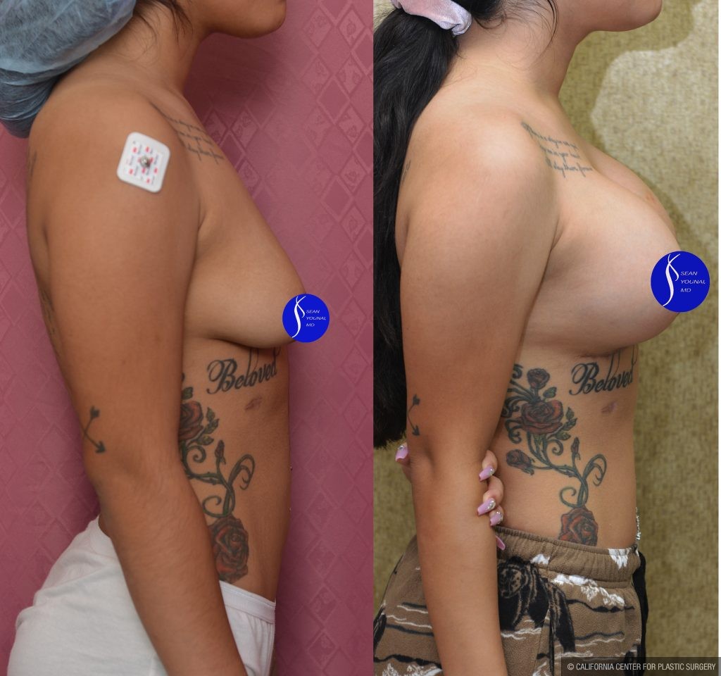 Breast Lift - Moderate Before & After Patient #13867