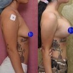 Breast Lift - Moderate Before & After Patient #13867