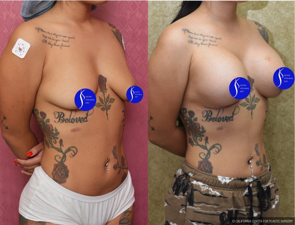 Breast Lift - Moderate Before & After Patient #13867