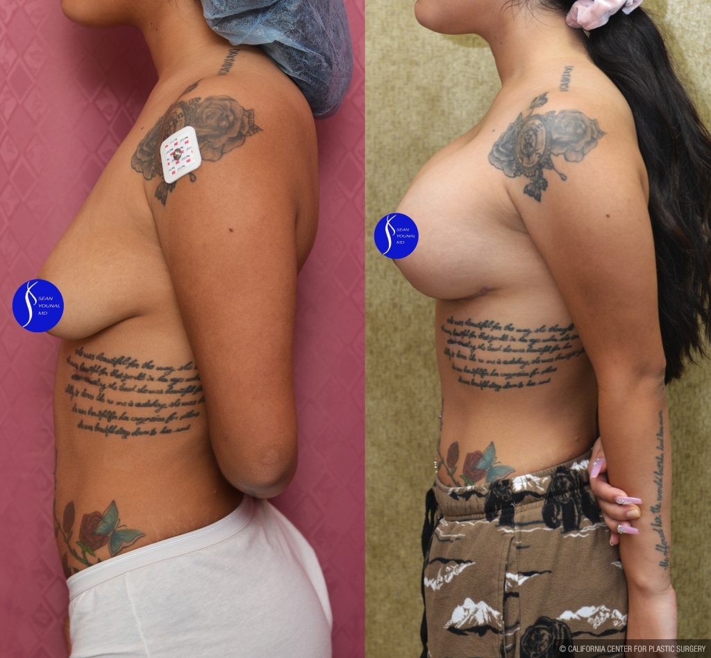 Breast Lift - Moderate Before & After Patient #13867