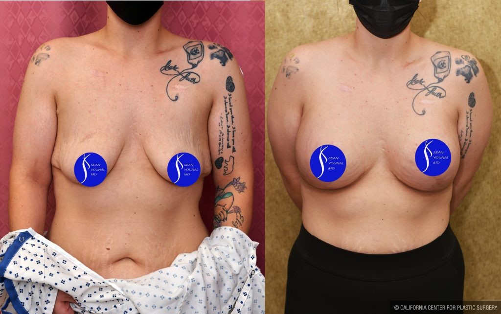 Breast Lift - Limited Before & After Patient #13868