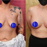 Breast Lift - Limited Before & After Patient #13868