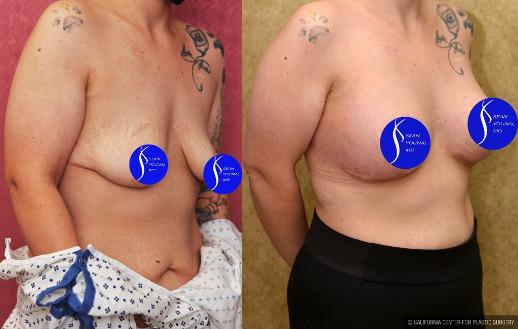 Breast Lift - Limited Before & After Patient #13868