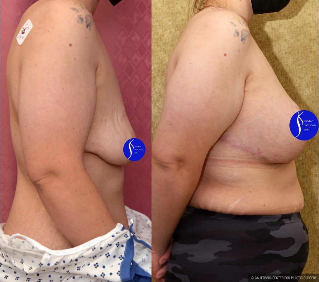 Breast Lift - Limited Before & After Patient #13868