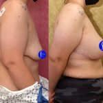 Breast Lift - Limited Before & After Patient #13868