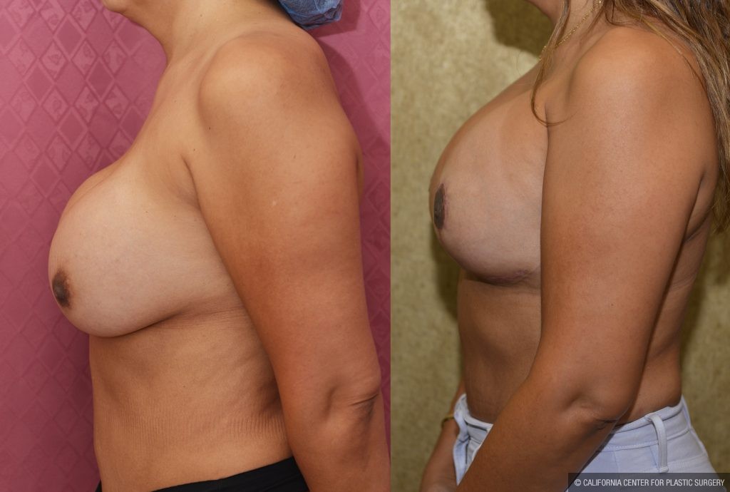 Breast Augmentation (Revision) Before & After Patient #13869
