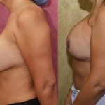 Breast Augmentation (Revision) Before & After Patient #13869