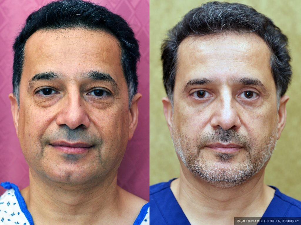 Eyelid (Blepharoplasty) Before & After Patient #13871