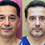 Eyelid (Blepharoplasty) Before & After Patient #13871