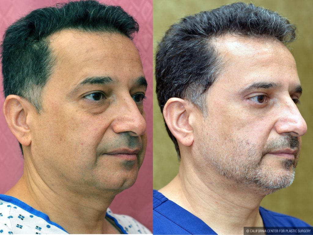 Eyelid (Blepharoplasty) Before & After Patient #13871