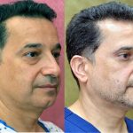 Eyelid (Blepharoplasty) Before & After Patient #13871