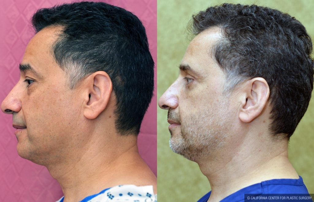 Eyelid (Blepharoplasty) Before & After Patient #13871