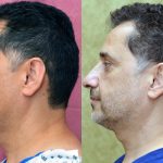 Eyelid (Blepharoplasty) Before & After Patient #13871