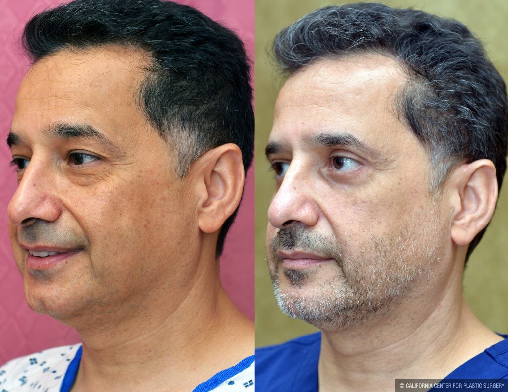 Eyelid (Blepharoplasty) Before & After Patient #13871