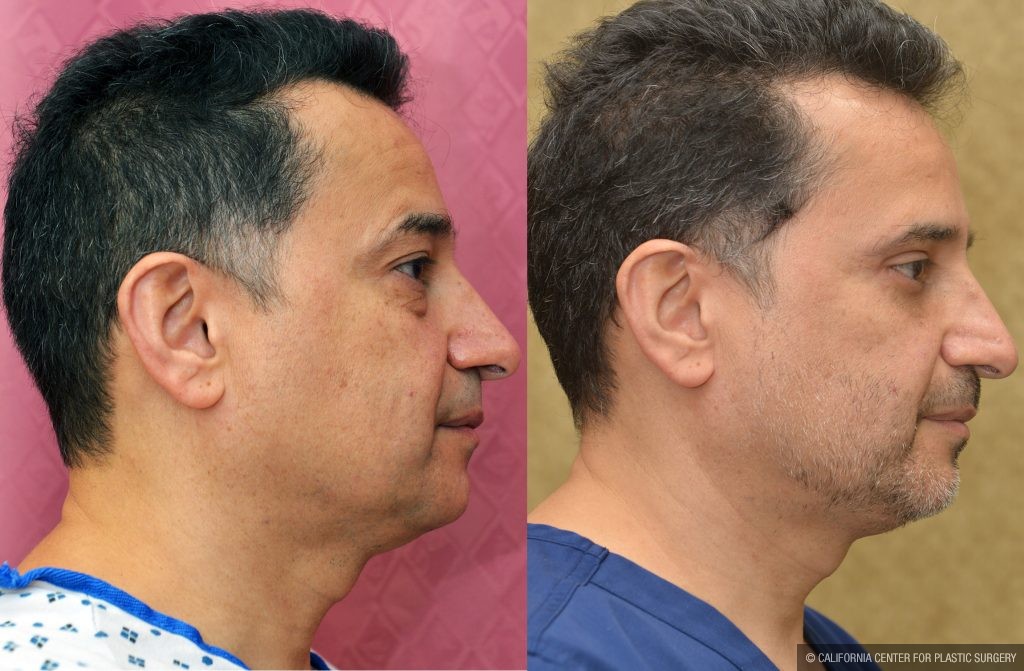 Eyelid (Blepharoplasty) Before & After Patient #13871