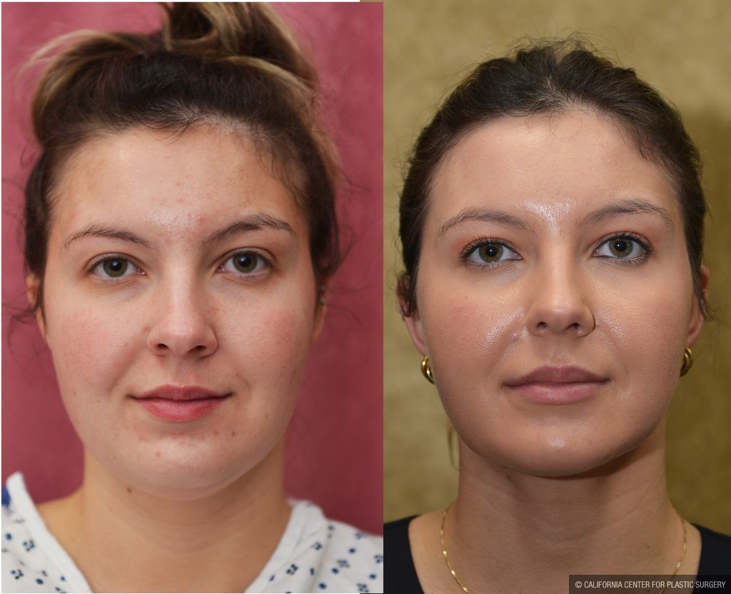 Neck & Face Liposuction Before & After Patient #13865