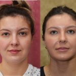 Neck & Face Liposuction Before & After Patient #13865