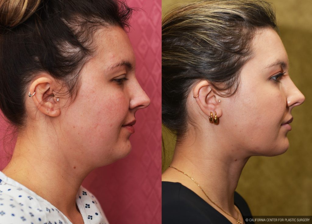 Neck & Face Liposuction Before & After Patient #13865