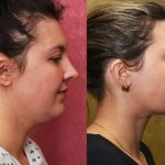 Neck & Face Liposuction Before & After Patient #13865