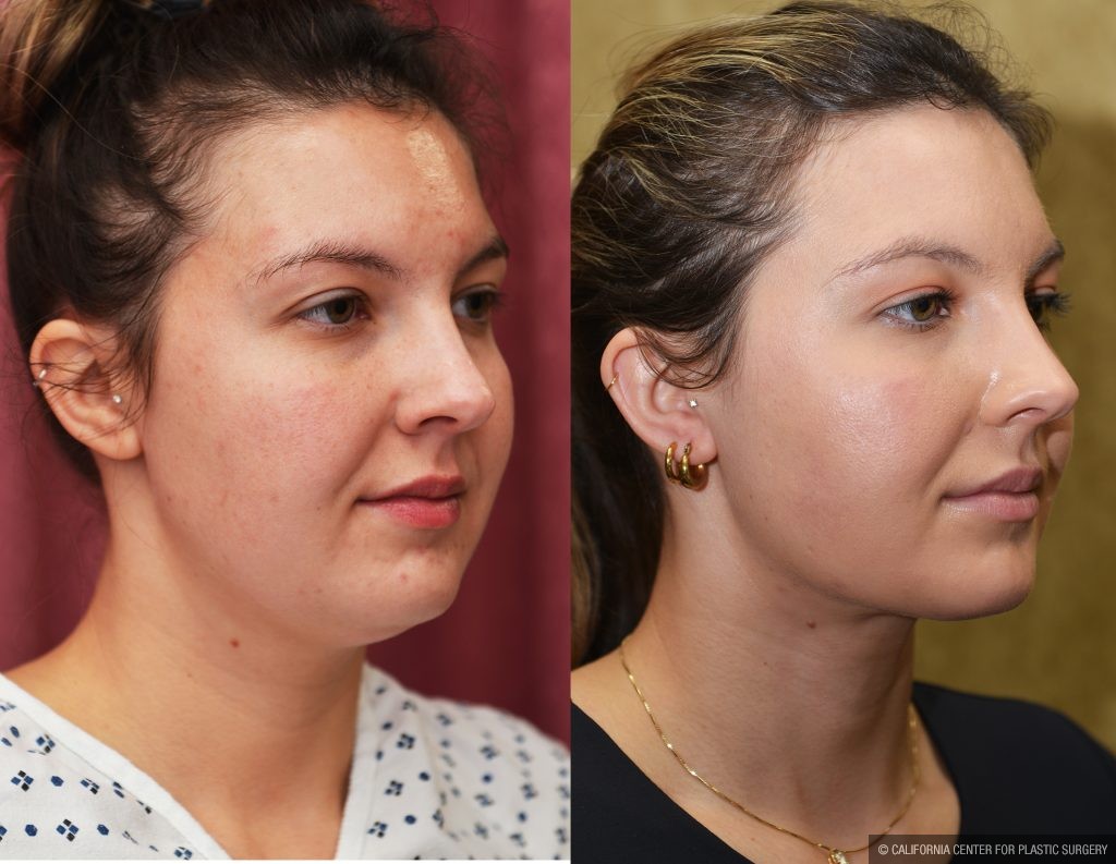 Neck & Face Liposuction Before & After Patient #13865