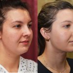 Neck & Face Liposuction Before & After Patient #13865