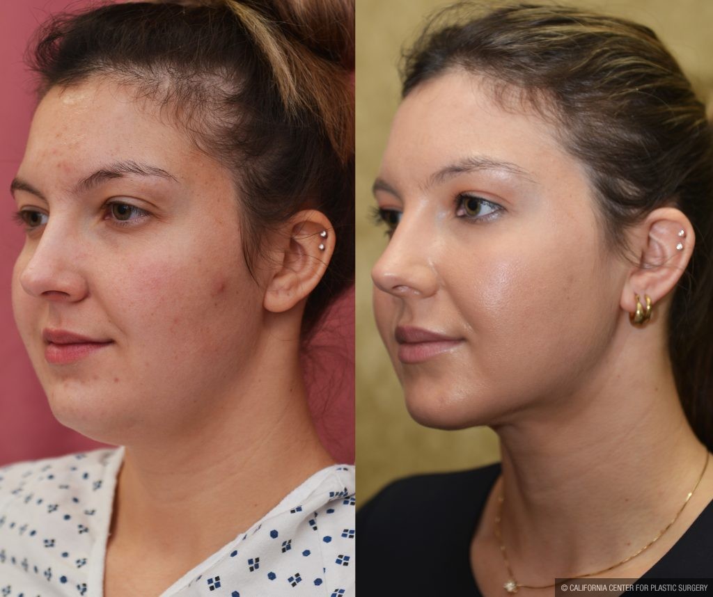 Neck & Face Liposuction Before & After Patient #13865