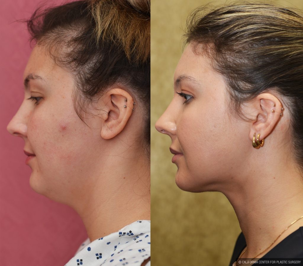 Neck & Face Liposuction Before & After Patient #13865