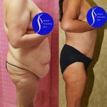 Tummy Tuck (Abdominoplasty) Plus Size Before & After Patient #13874