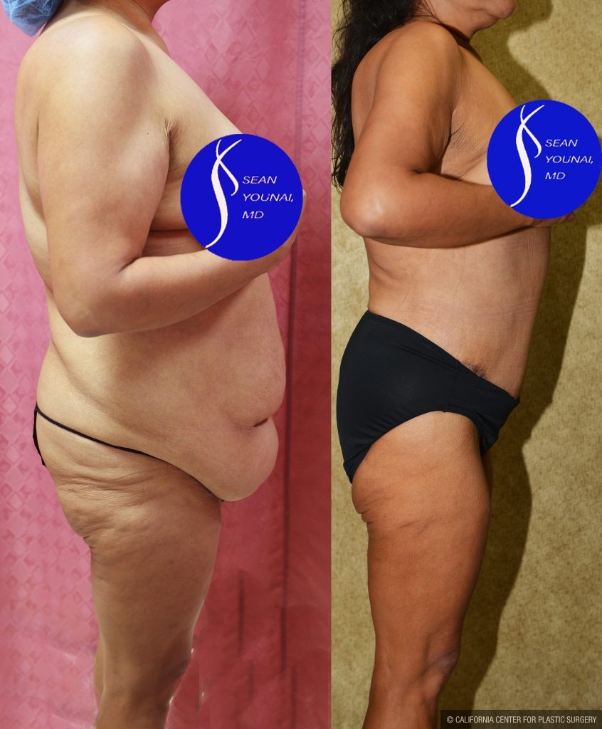 Tummy Tuck (Abdominoplasty) Plus Size Before & After Patient #13874