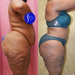 African American Tummy Tuck (Abdominoplasty) Before & After Patient #13873