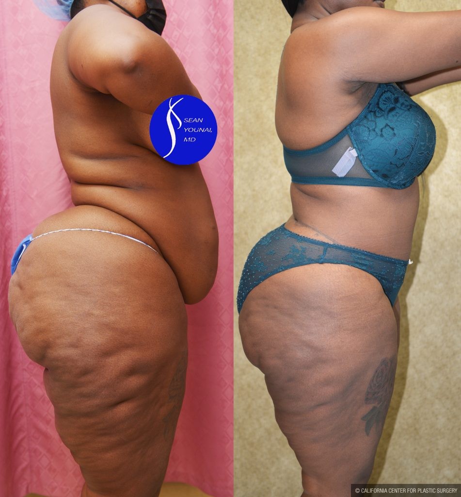 African American Tummy Tuck (Abdominoplasty) Before & After Patient #13873