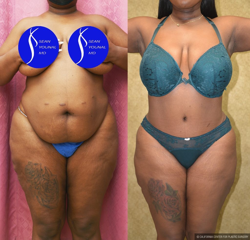 African American Tummy Tuck (Abdominoplasty) Before & After Patient #13873