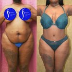 African American Tummy Tuck (Abdominoplasty) Before & After Patient #13873
