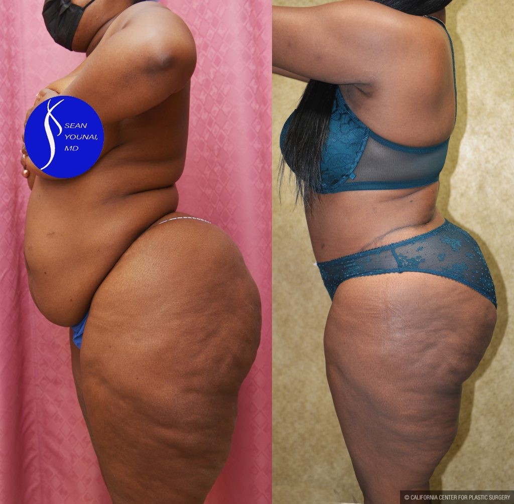 African American Tummy Tuck (Abdominoplasty) Before & After Patient #13873