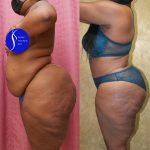 African American Tummy Tuck (Abdominoplasty) Before & After Patient #13873