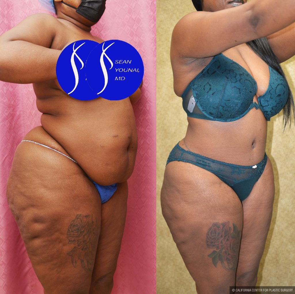 African American Tummy Tuck (Abdominoplasty) Before & After Patient #13873