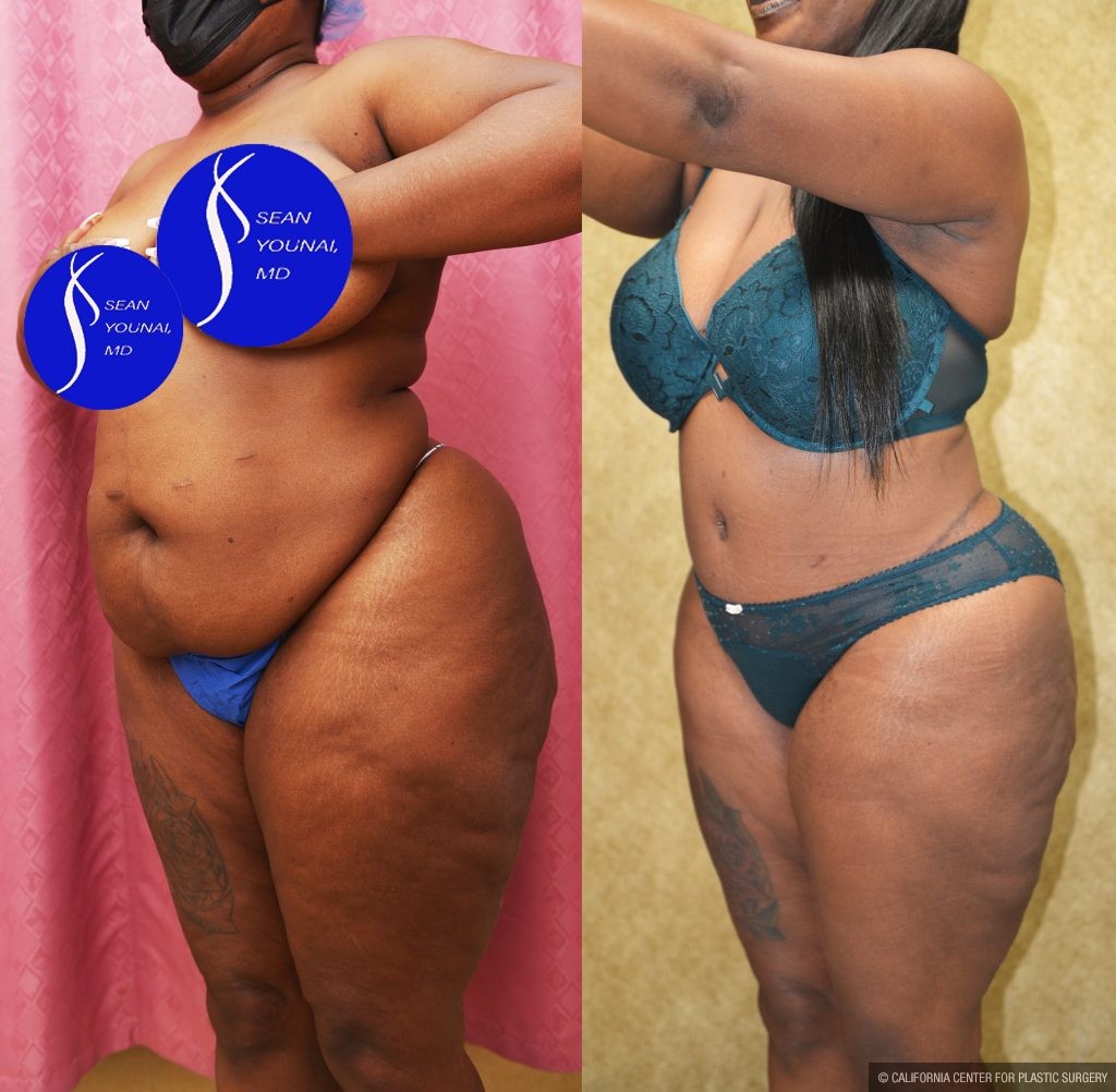African American Tummy Tuck (Abdominoplasty) Before & After Patient #13873
