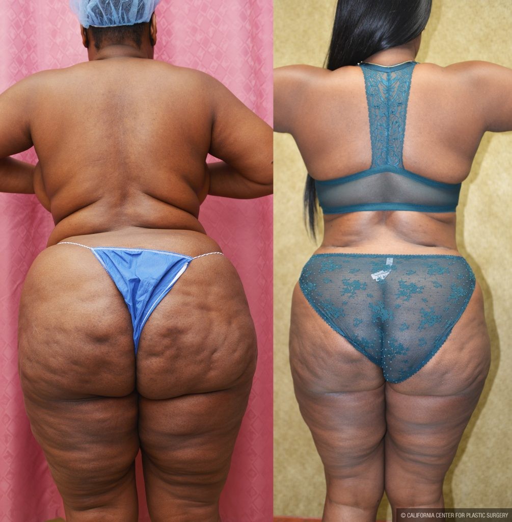 African American Tummy Tuck (Abdominoplasty) Before & After Patient #13873