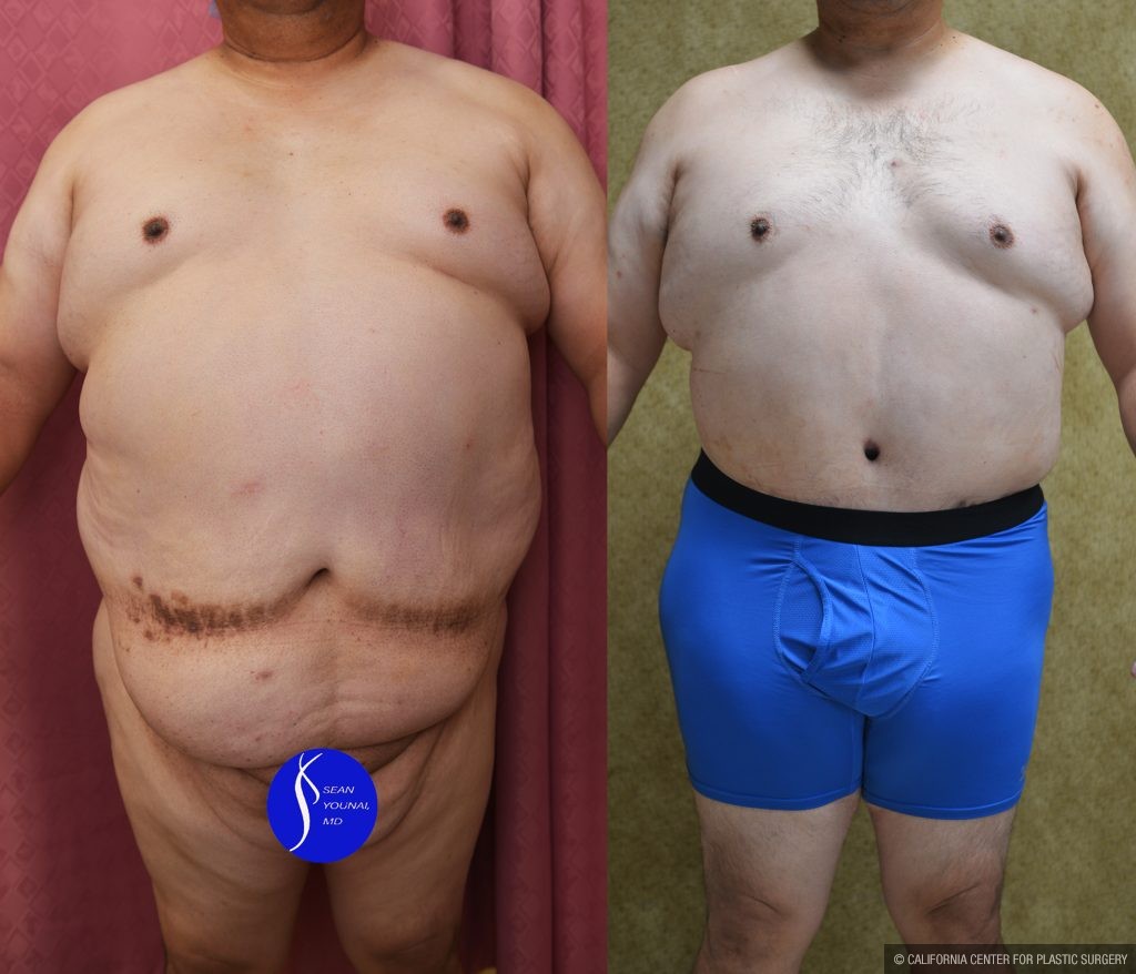 Male Tummy Tuck (abdominoplasty) Before & After Patient #13863