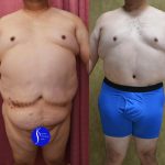 Male Tummy Tuck (abdominoplasty) Before & After Patient #13863