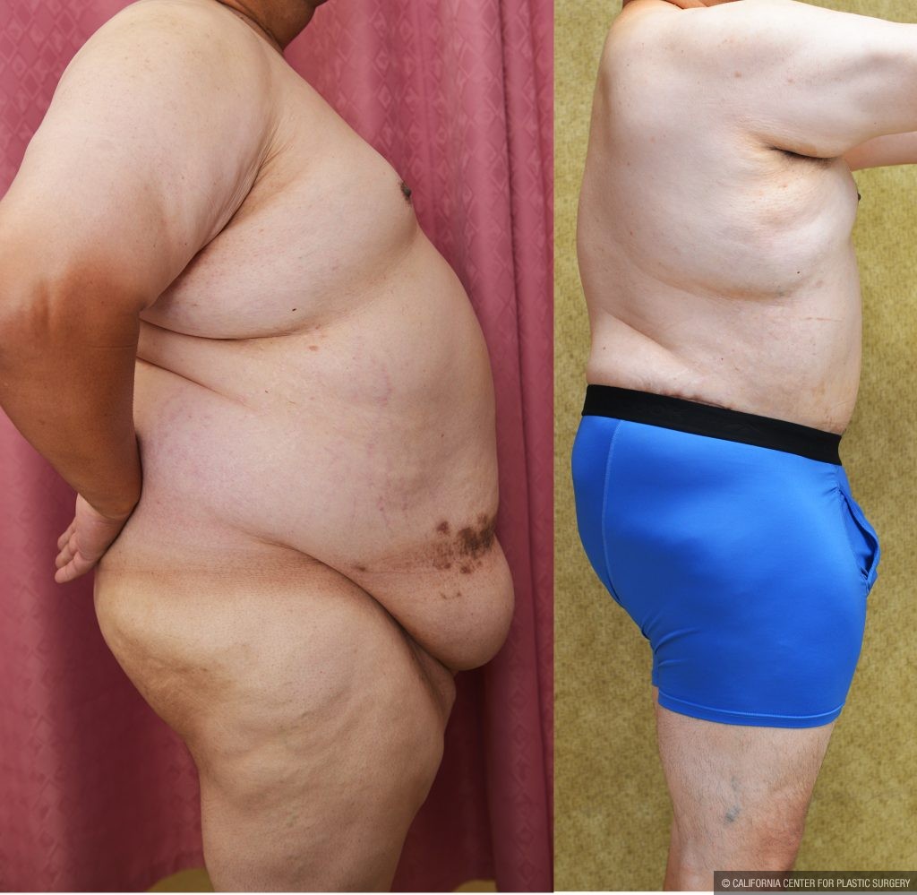 Male Tummy Tuck (abdominoplasty) Before & After Patient #13863