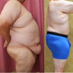 Male Tummy Tuck (abdominoplasty) Before & After Patient #13863