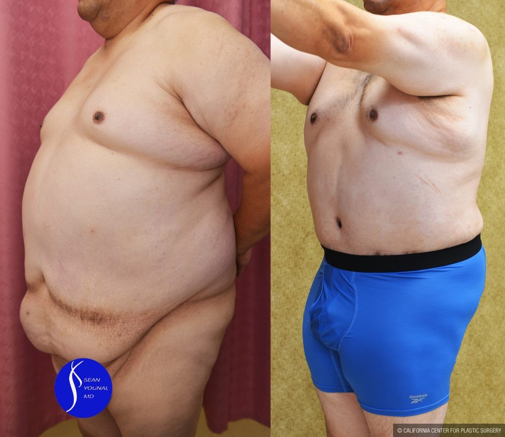 Male Tummy Tuck (abdominoplasty) Before & After Patient #13863