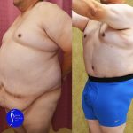 Male Tummy Tuck (abdominoplasty) Before & After Patient #13863