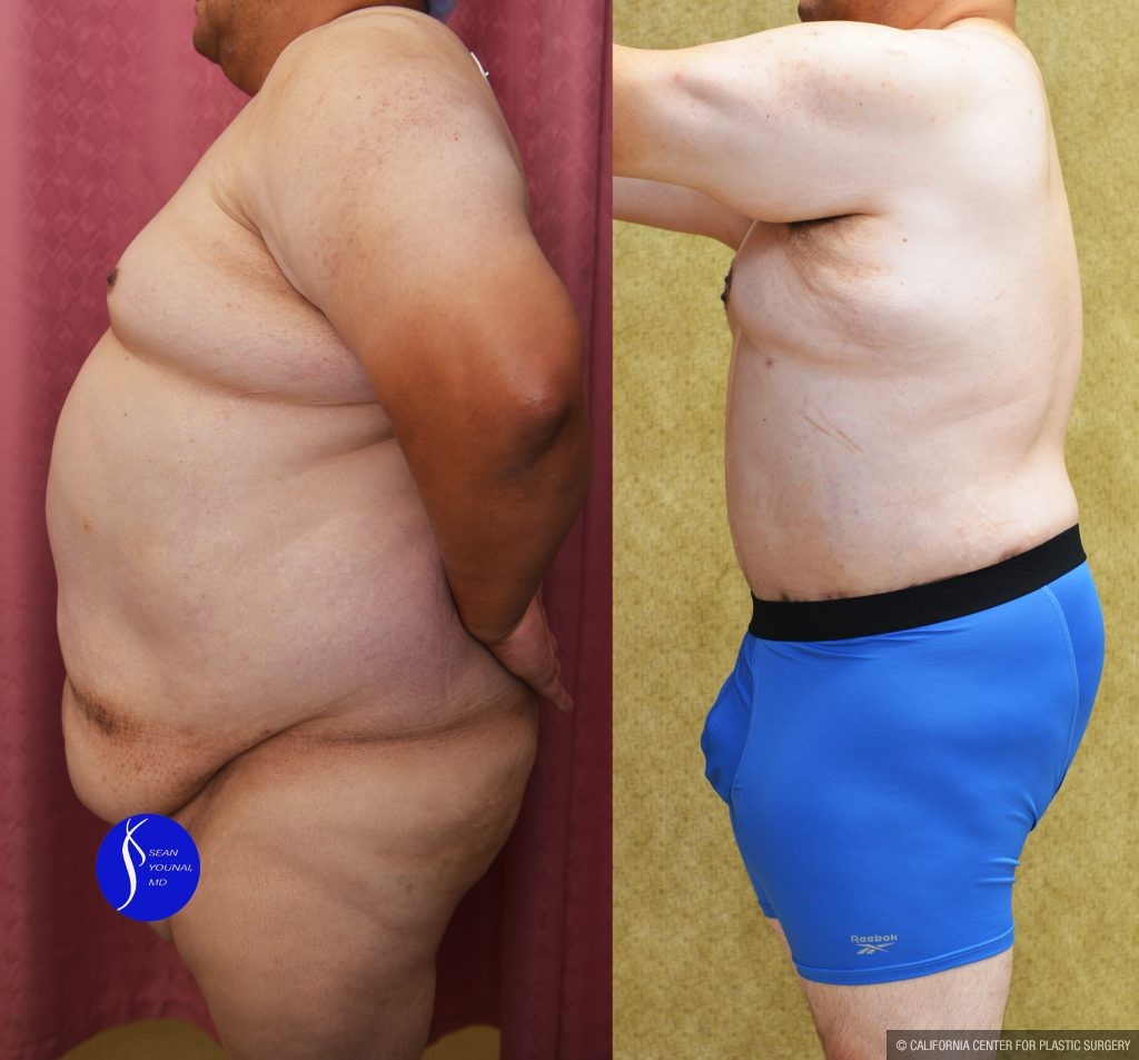 Male Tummy Tuck (abdominoplasty) Before & After Patient #13863
