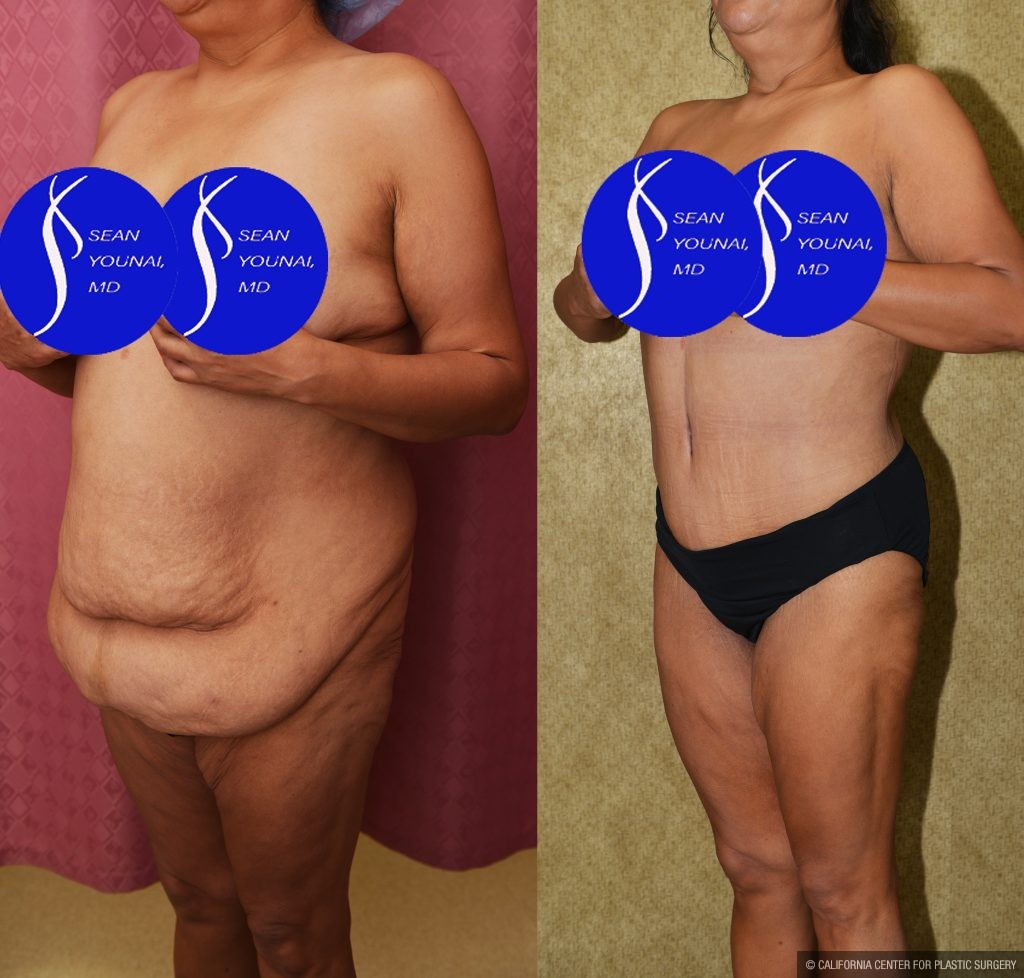 Tummy Tuck (Abdominoplasty) Plus Size Before & After Patient #13874