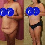 Tummy Tuck (Abdominoplasty) Plus Size Before & After Patient #13874